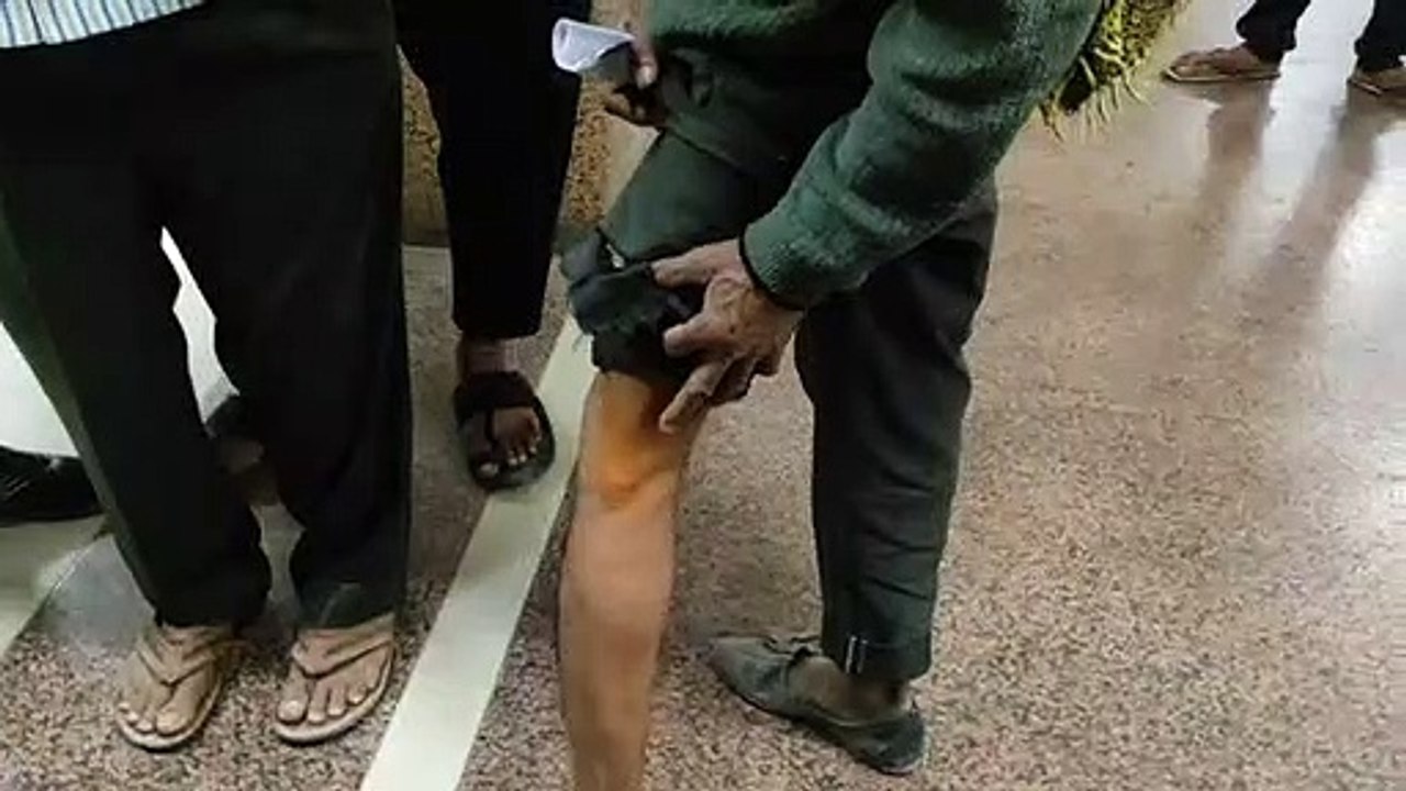 देखें Video...श्वान का आतंक : 29 जनों को किया ज...