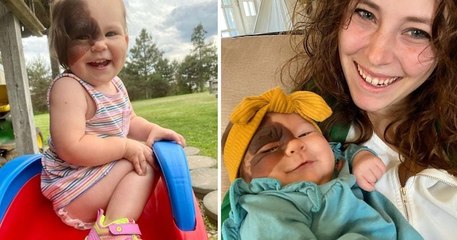 Née avec une tache de naissance très rare sur le visage, cette fillette respire la joie de vivre