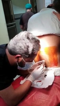 How to give spinal Anesthesia by Anesthesia Technologist