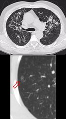 SIGNO DE LA GALAXIA Y SIGNO DEL CÚMULO SARCOIDEO