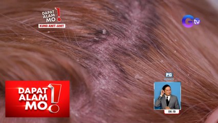 Problemang makating anit, paano maiibsan? | Dapat Alam Mo!