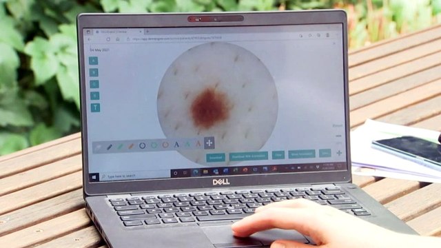 Personalised vaccine trail for melanomas hailed a breakthrough