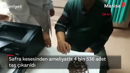 Safra kesesinden 4 bin 536 taş çıktı