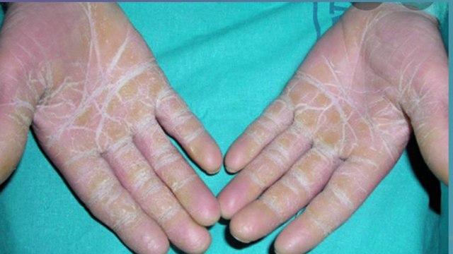 bd-causas-sintomas-y-posibles-tratamientos-de-piel-seca-151222