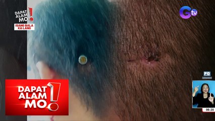 Tricycle driver na pinagbabaril sa ulo, ‘di umano tumagos ang bala sa bungo at nakatusok lang! | Dapat Alam Mo!