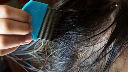 وصفات للقمل والصئبان_ أسرع طريقة للتخلص من القمل