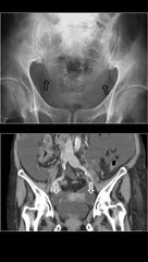 SIGNO DE LAS OREJAS DE PERRO