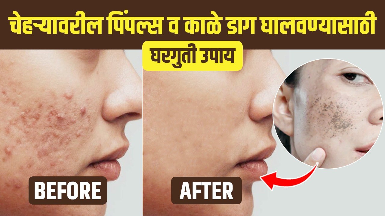 पिंपल्स आणि पिंपल्सचे डाग घालवण्यासाठी उपाय | Natural Remedies To Get Rid Of Dark Spot | Dark Spot