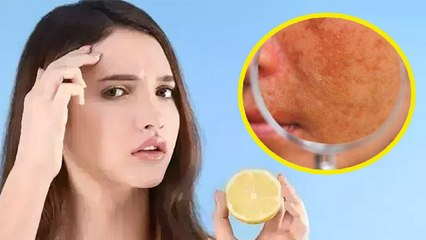 चेहरे पर नींबू रगड़ने से क्या होता है | चेहरे पर नींबू रगड़ना चाहिए या नहीं | Boldsky *health