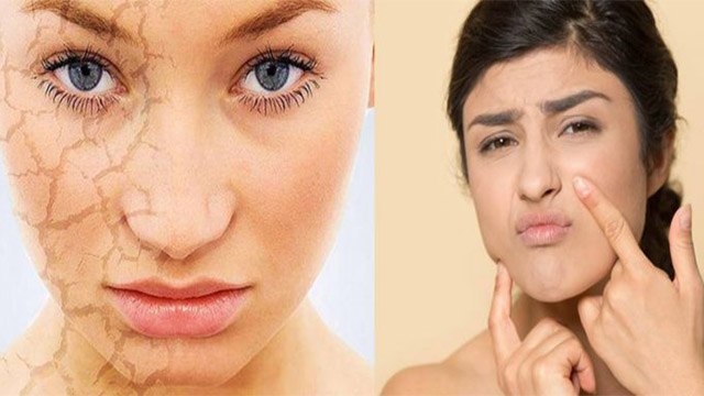 ठंड में ड्राई स्किन ध्यान रखने का सही तरीका । ठंड में ड्राई स्किन का कैसे करें केयर । Boldsky