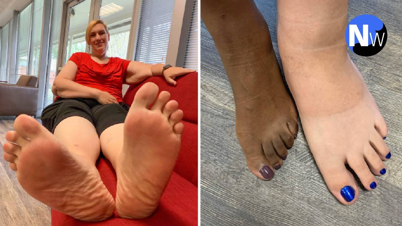 Biggest feet in the world: Woman's size 18 feet need custom-made shoes