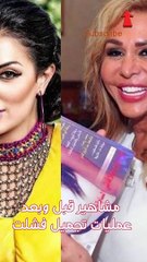 مشاهير قبل وبعد عمليات تجميل فشلت
