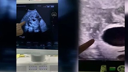 Anne karnındaki bebeğe stent takıldı