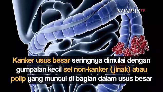 Ini Penyebab Penyakit Kanker Usus yang Menyerang Pele