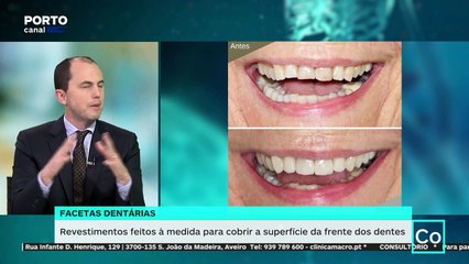 Consultório 20 dezembro, parte 3 - Facetas dentárias