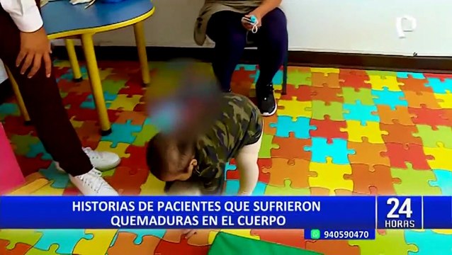 Historias de pacientes que sufrieron quemaduras en el cuerpo