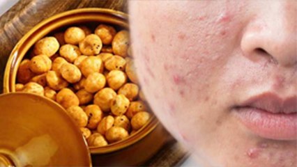 मखाना Fry करके खाने से इस गंभीर बीमारी का खतरा, Fry Makhana खाने के नुकसान | Boldsky *Health