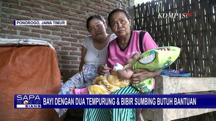 Terkendala Biaya, Bayi dengan 2 Tempurung dan Bibir Sumbing di Ponorogo Butuh Tindakan Medis