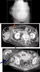 SIGNO DE LA PARED ABDOMINAL INCOMPLETA