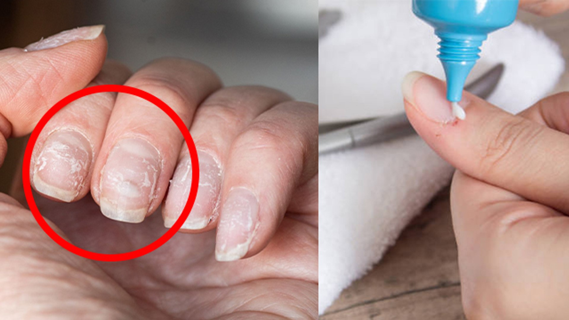 Nail Slugging क्या है, नाखून के आसपास की त्वचा निकलने पर करें ये उपाय  |Boldsky*Health - video Dailymotion