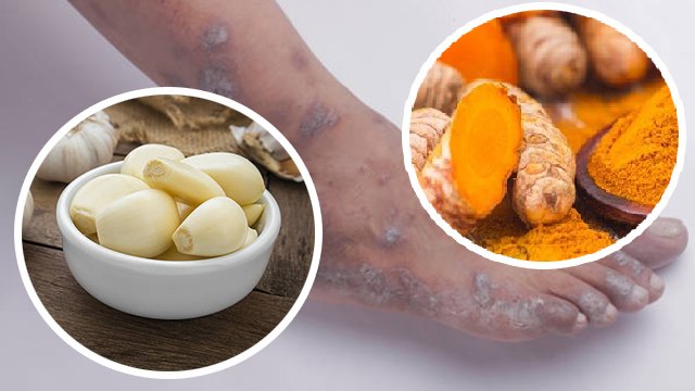 Fungal Infection में क्या खाना चाहिए क्या नहीं । Fungal Infection me kya khana chahiye kya nahi ।