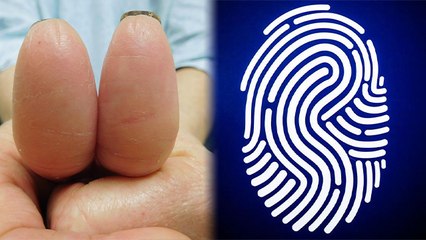 Adermatoglyphia क्या है, इस बीमारी में Fingerprint क्यों हो जाते हैं गायब | Boldsky *Health