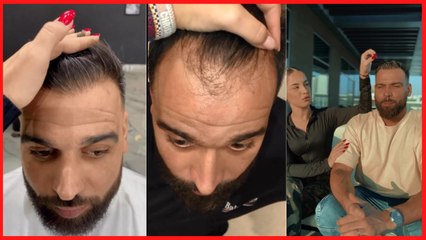 Noré dévoile sa greffe de cheveux et choque les internautes !