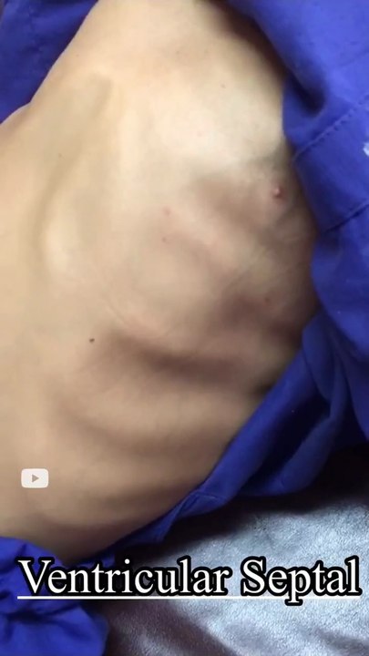 _Ventricular Septal defect_ Apex of the Heart beating _ congenital heart defects _ vsd