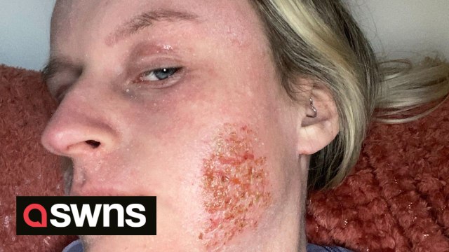 Woman housebound after cream she used to treat eczema caused skin to weep and scab