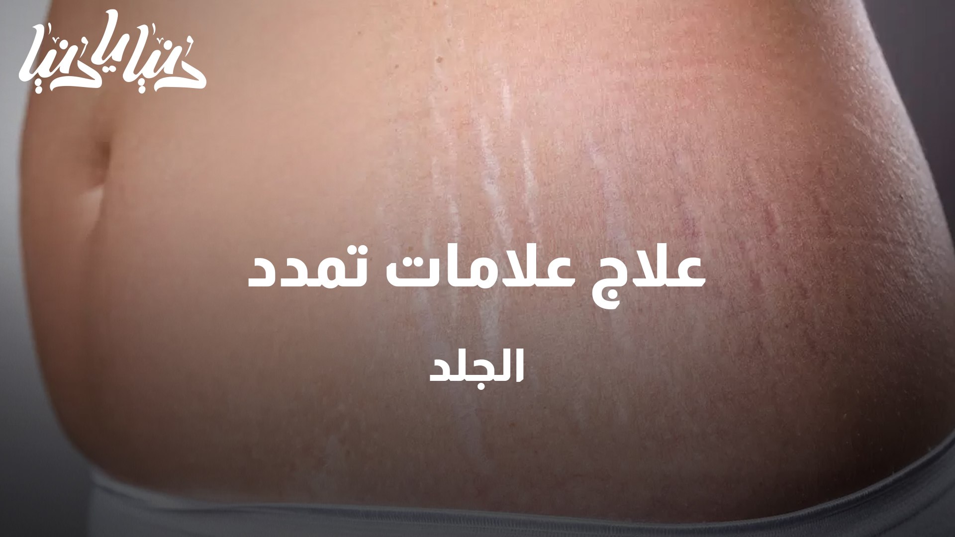علاج علامات تمدد الجلد - فيديو Dailymotion
