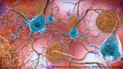 New drug shows promise against Alzheimer's