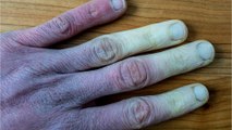 Raynaud-Syndrom: Das kann man gegen Leichenfinger tun