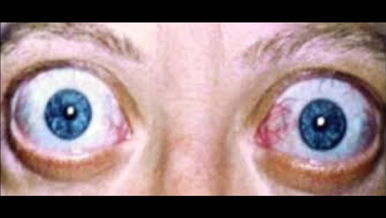 exophtalmie traitée par décompression graisseuse orbitaire, explications Vladimir Mitz