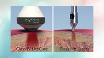 Tired of living in pain? Laser Pain Away™ announces LightForce® XLi  40 watt Deep Tissue Therapy Laser
