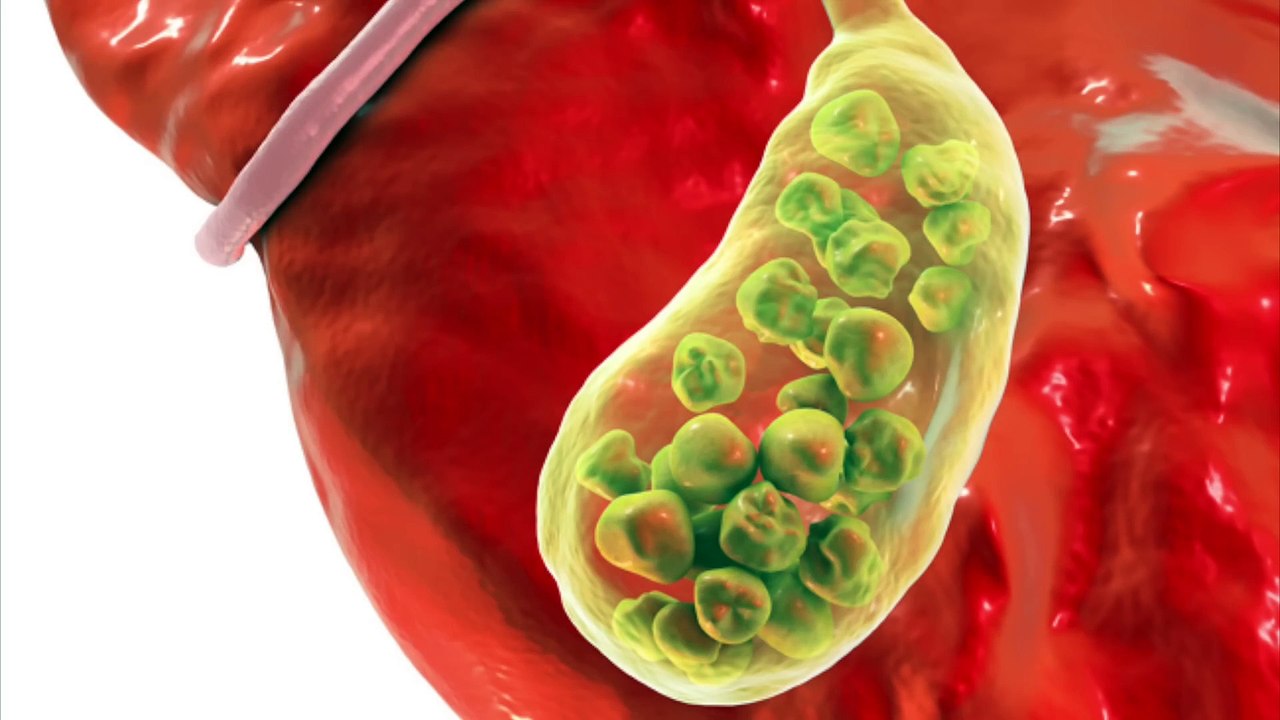 How to Rid Your Xanthomas (Naturally)-dr burg