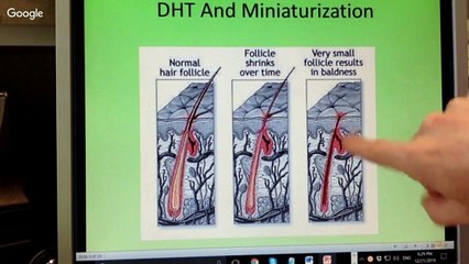 Why Common Hair Loss Treatments may not be the Best Option for you