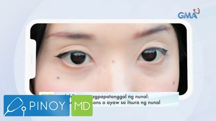 P’wede bang ipatanggal lahat ng nunal sa katawan?  | Pinoy MD