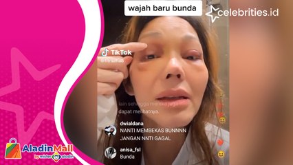 Ini Penampilan Bunda Corla Paska Operasi Plastik