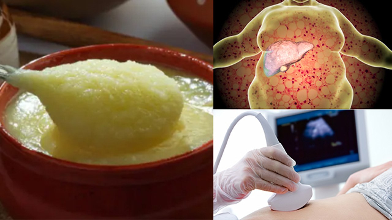 फैटी लिवर में घी खाना चाहिए कि नहीं Fatty Liver Me Ghee Khana Chahiye Ki Nahi Boldsky