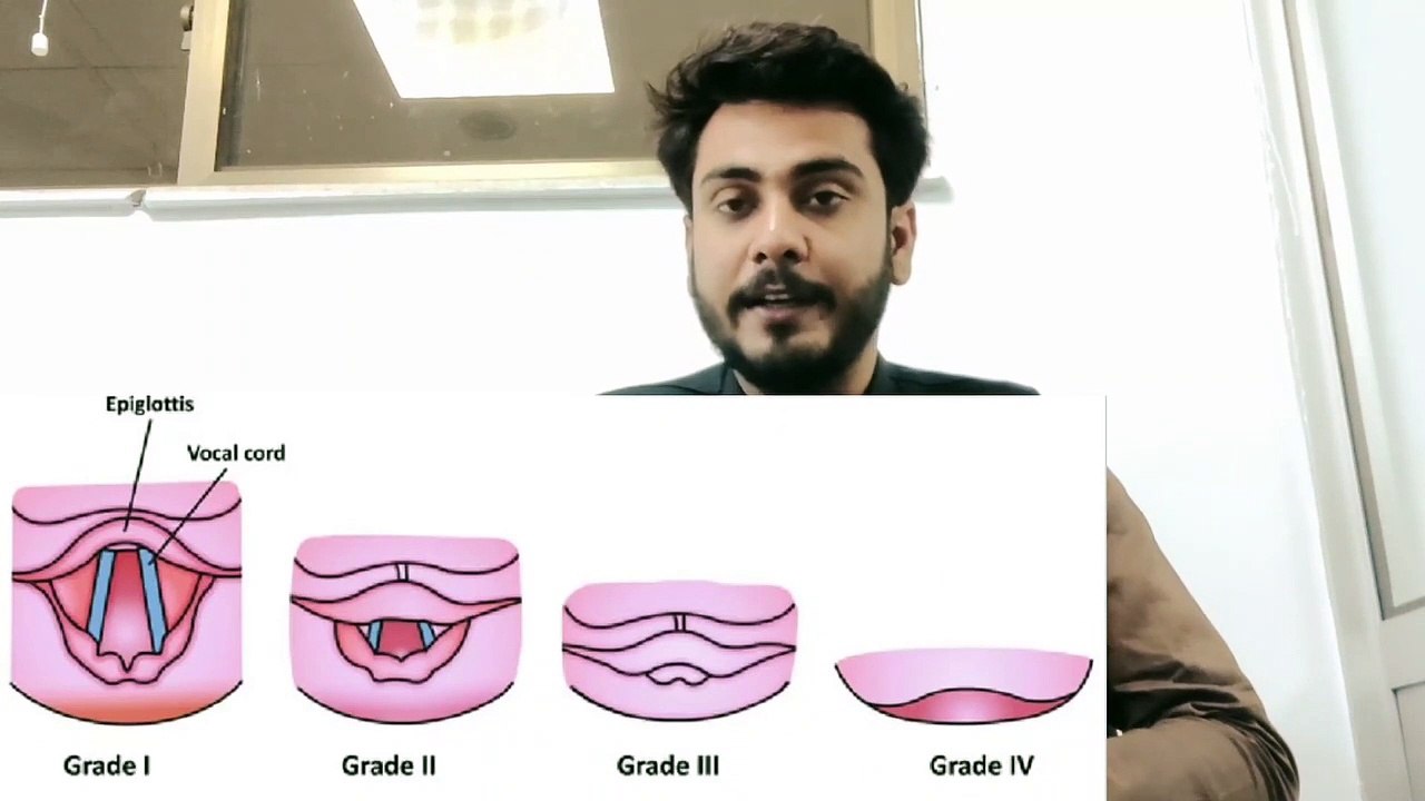 Cotman and lehans laryngoscopy Grading in Urdu Hindi by Anesthesia Technologist