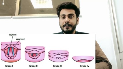 Cotman and lehans laryngoscopy Grading in Urdu Hindi by Anesthesia Technologist