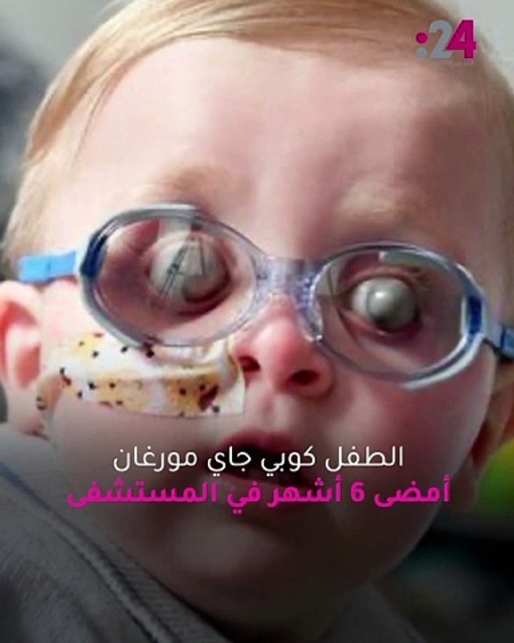 عينان جاحظتان ومنتفختان.. حالة مرضية غامضة لمولود تحير الأطباء