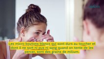 Micro boutons blancs : comment s'en débarrasser ?