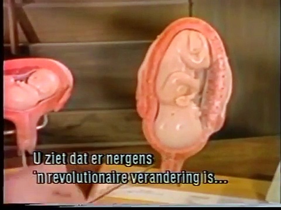 Dit is het tweede deel van de video: Weet je wat een geïnduceerde abortus inhoudt? Wetenschappelijk-pedagogische educatieve video over geïnduceerde abortus in het Nederlands .MP4