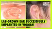 Lab-grown ear successfully implanted in man | NEXT NOW