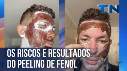 Os riscos e o resultado do peeling de fenol