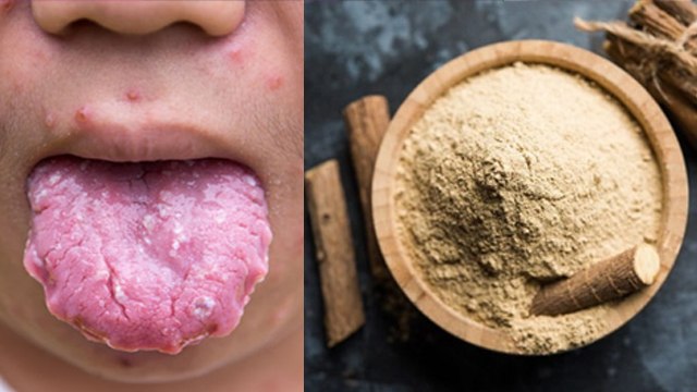 मुंह में बार बार छाले होने पर क्या करें | मुंह में बार बार छाले होने का कारण क्या है | Boldsky