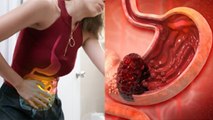 आंत में गांठ क्यों होती है | आंत में गांठ का इलाज | Aant Me Ganth Kyu Hoti Hai | Boldsky