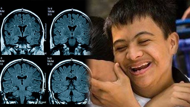 ऑटिज्म क्यों होता है | Autism Kyu Hota Hai | Autism Symptoms और Treatment क्या है | Boldsky