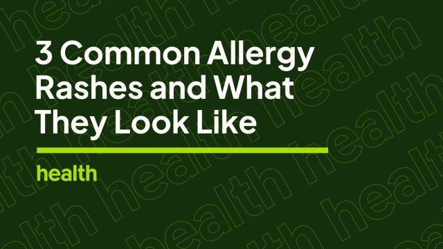 Deep Dives: 3 Common Allergy Rashes
